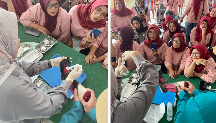 Luka Diabetes Bisa Pulih Lebih Cepat, Ini Rahasia ULCUMED Inovasi Tim Stikes Karsa Husada Garut 1 Luka Diabetes Bisa Pulih Lebih Cepat Ini Rahasia ULCUMED Invovasi Tim Stikes Karsa Husada Garut 1